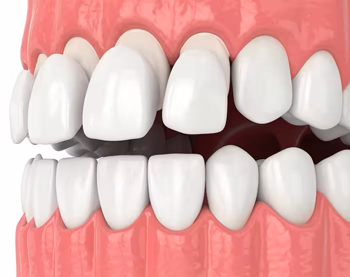 Composite veneer