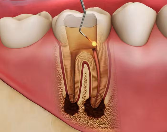 Root canal and filling