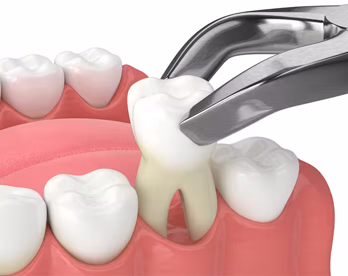 Tooth extraction